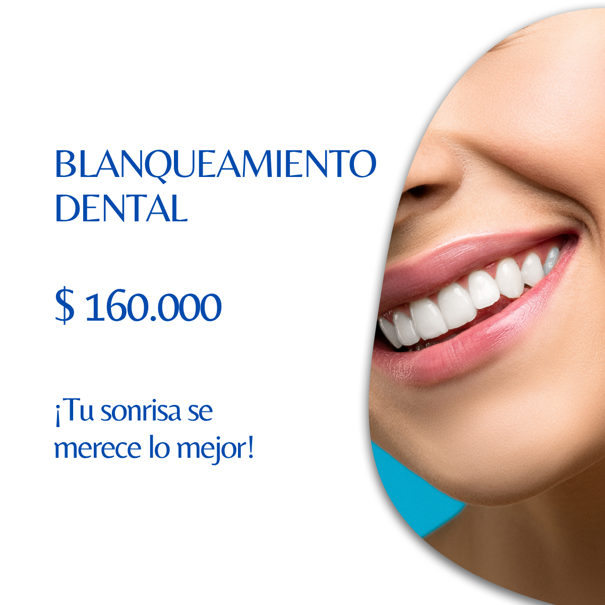 Blanqueamiento Dental